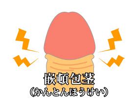 かんとんほう|かんとんほうけい 嵌頓包茎